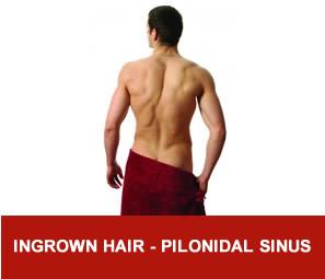 Ingrown hair - pilonidal sinus